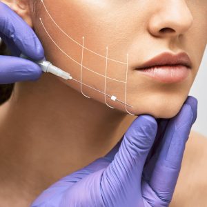 Thread Lift Procedure in Bangalore