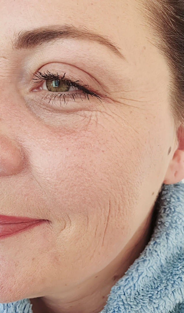 Women Face Anti Wrinkle after Treatment