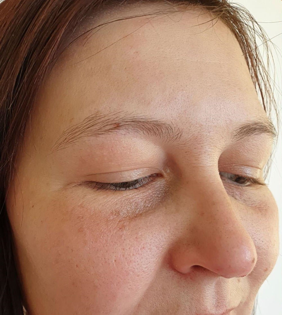 Women Face MNRF after Treatment
