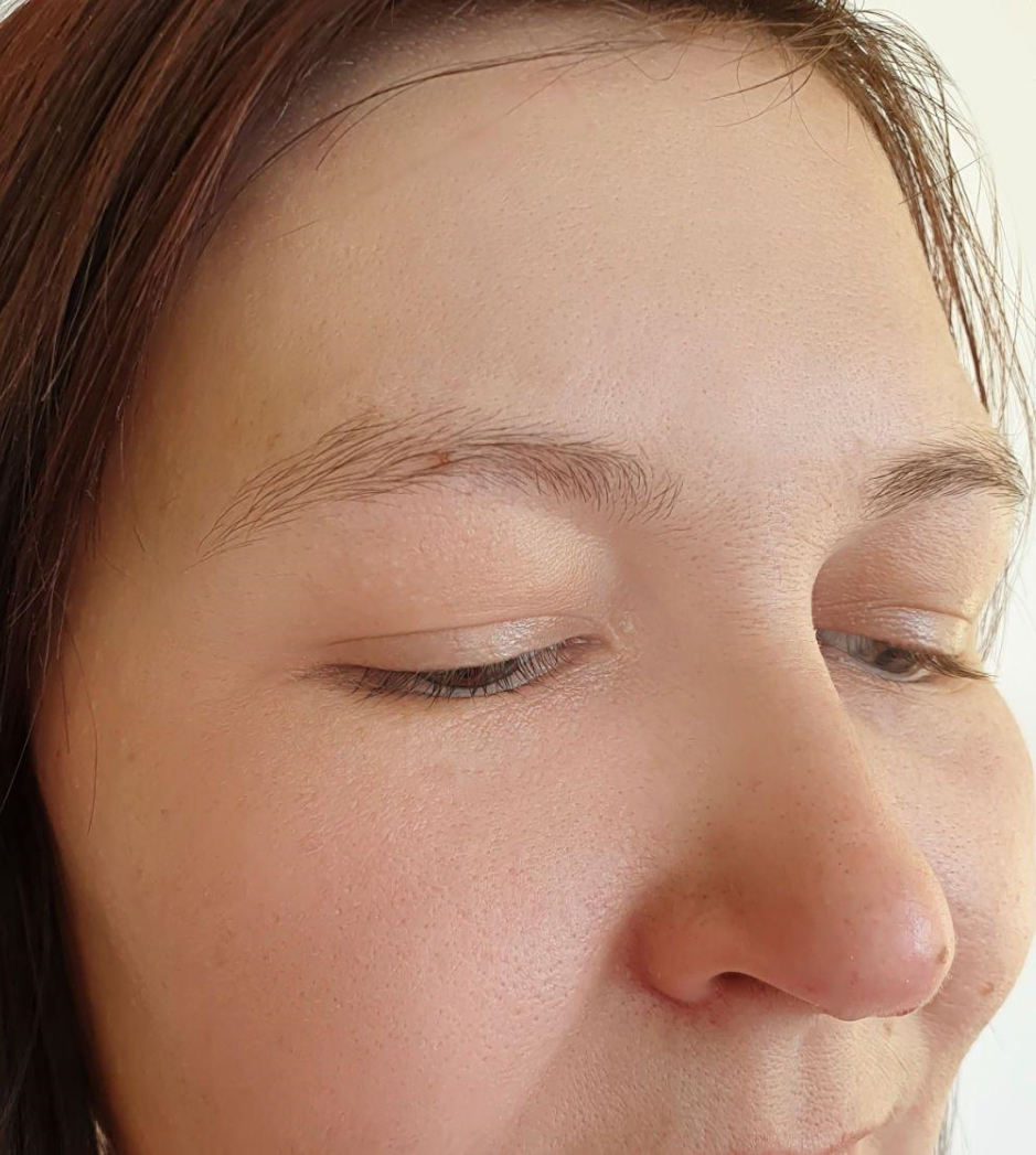 Women Face MNRF after Treatment