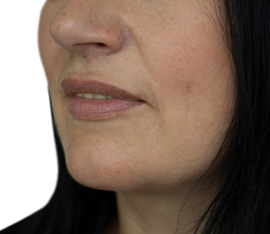 Women Face HIFU Facial after Treatment Women Face HIFU Facial after Treatment