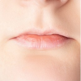 Women Face Filler after Treatment