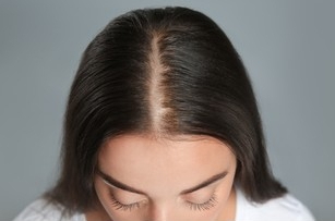 Women Hair Transformation after PRP Treatment Hair Fall Treatment in Bangalore