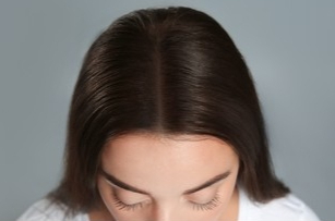 Women Hair Transformation after PRP Treatment