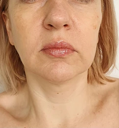 woman-face-lift-after-treatment-260nw-1501806911 woman-face-lift-after-treatment-260nw-1501806911
