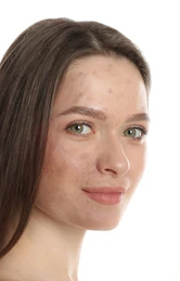 Women Face Chemical Peel after Treatment