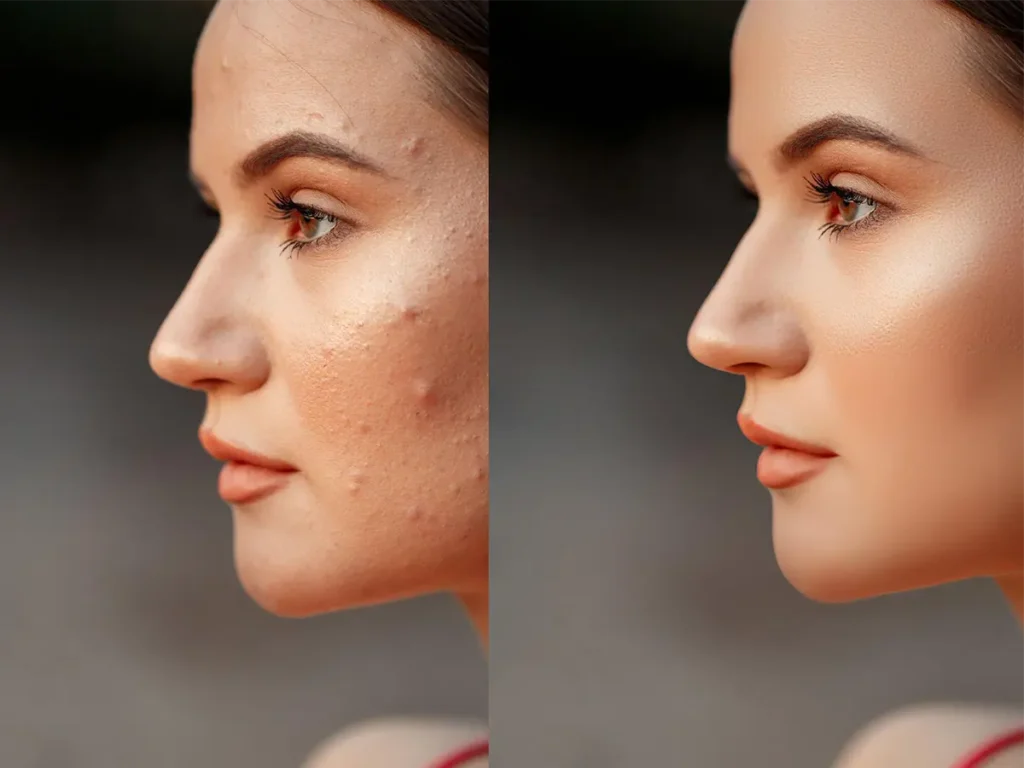 Hydra Facial vs IPL