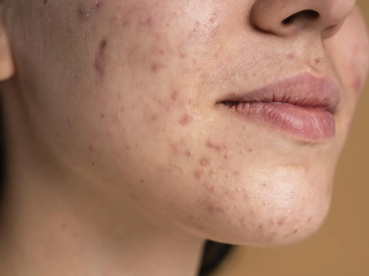 Acne scar removal in Bangalore