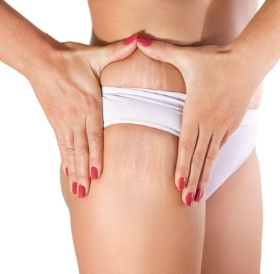 Stretch Marks Removal: Best Treatments by Skin Experts | Skinnfit Medspa