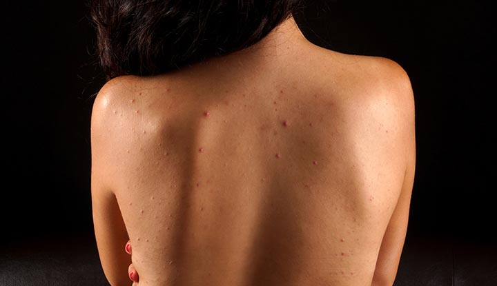 Body Pigmentation Treatment in Bangalore – Dark Neck, Underarms & More
