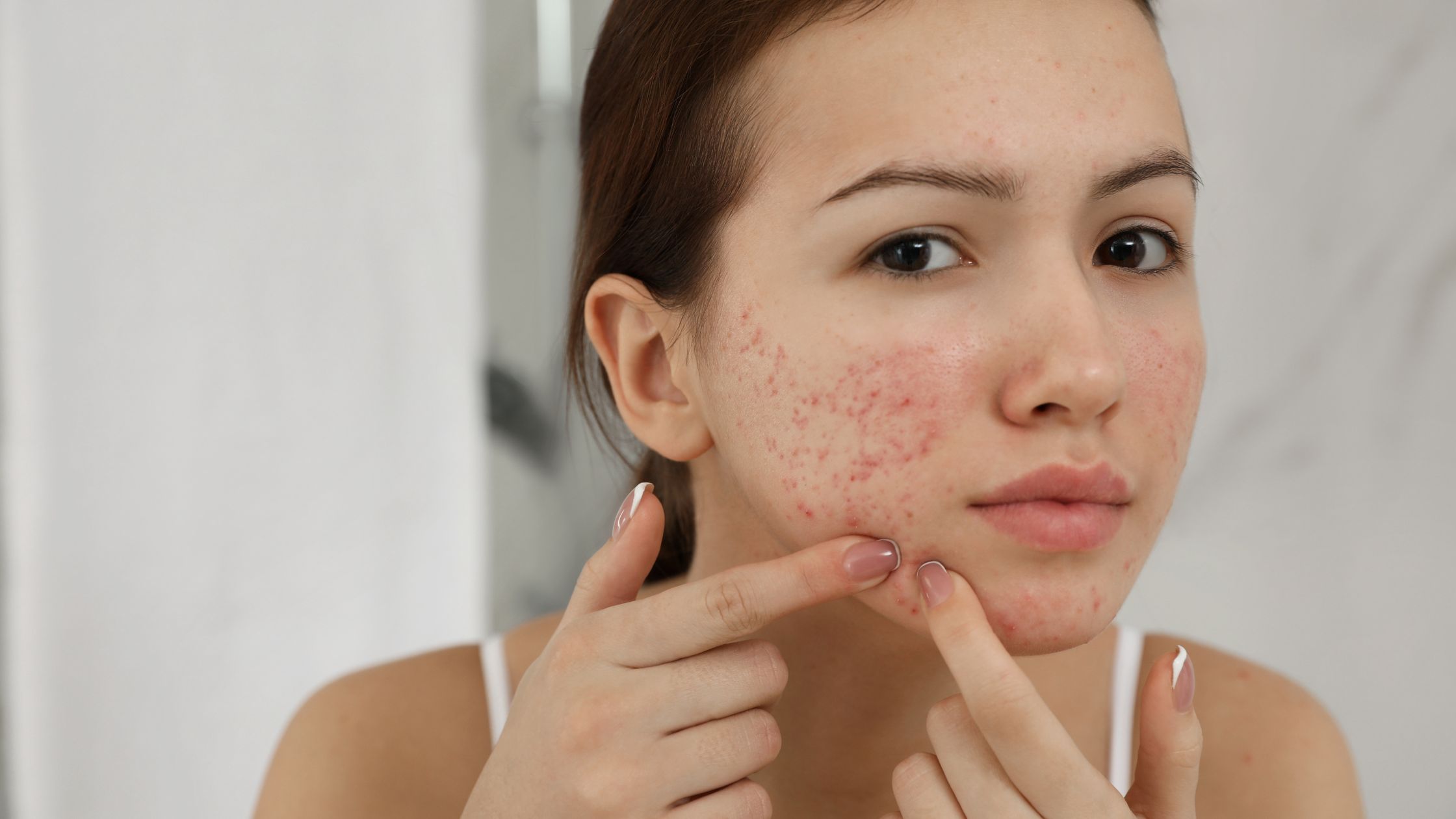Active Acne Treatment in Bangalore – Clear Skin with Dermatologist Care