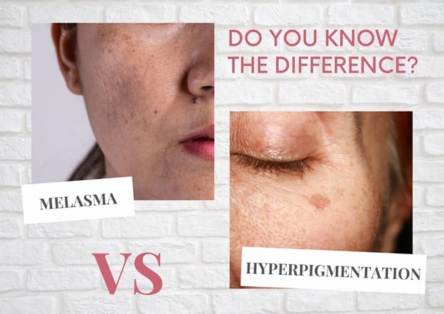 Melasma treatment in Bangalore
