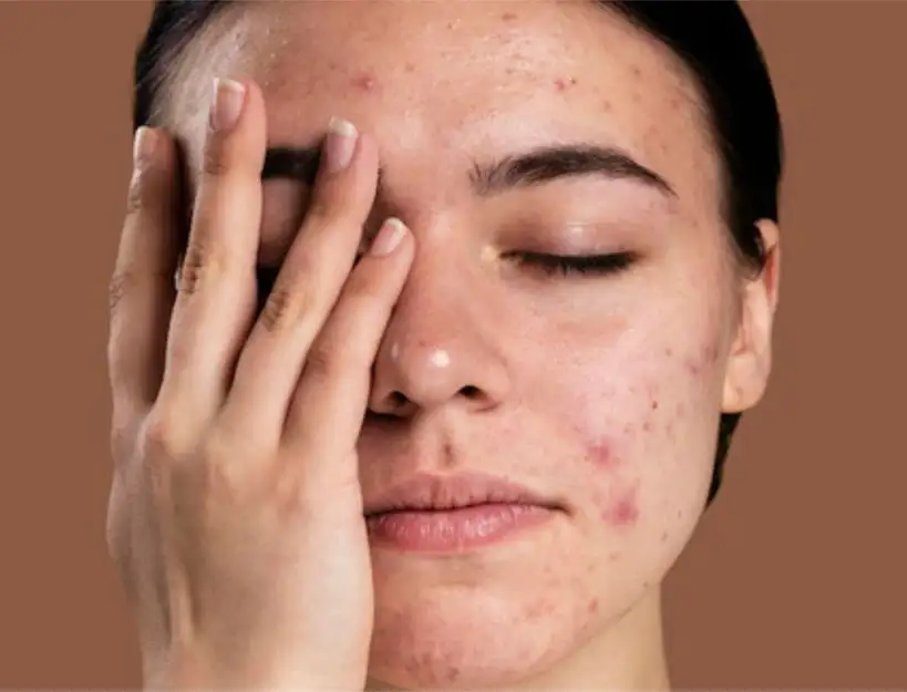 How to Remove Dark Spots Permanently | Skinnfit Medspa Bangalore